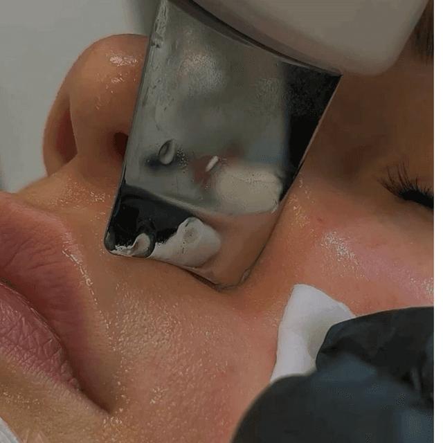 Acne Bootcamp at Esme Esthetics in Hoschton, GA